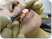 レーザー光線で見つける虫歯検査 レーザー光線で見つける虫歯検査