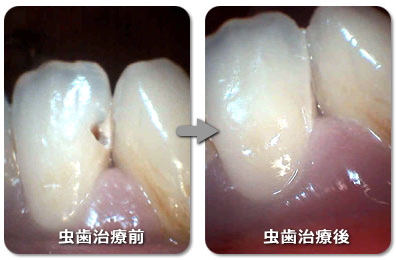 虫歯の治療前と後