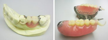 銀色バネの無い入れ歯