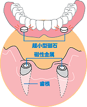 磁石式入れ歯 磁石式入れ歯