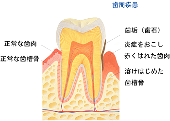 歯周病について 歯周病について