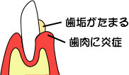 歯周病の進行1 歯周病の進行1