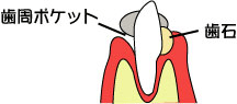 歯周病の進行2 歯周病の進行2