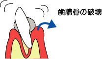 歯周病の進行4 歯周病の進行4