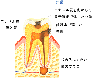 虫歯 虫歯