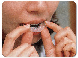 ホワイトニング