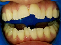 ホワイトニング前