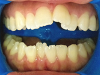 ホワイトニング後