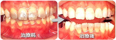 ホワイトニングの治療前と後