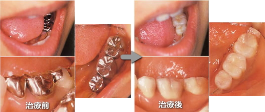 奥歯の白いかぶせもの、治療前と後