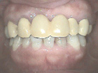 ２０年前に入れた差し歯